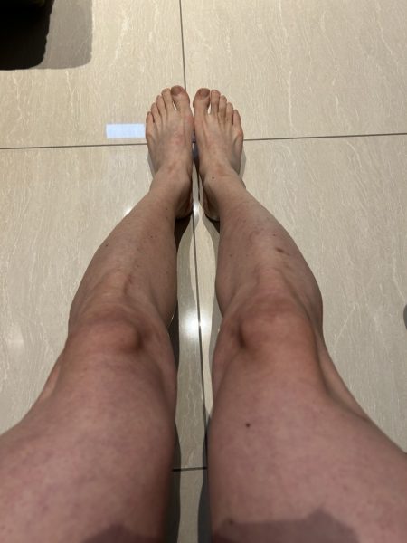 完全脱毛への道