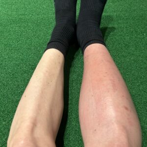 右足パンパンイタスの状況