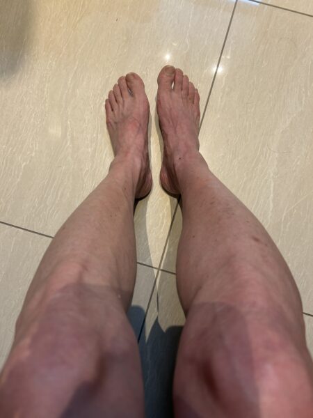 右足血栓ヤバス判明からの途中経過