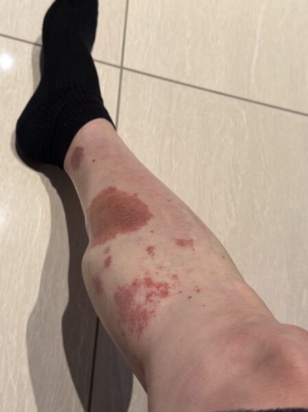 右足血栓の後遺症